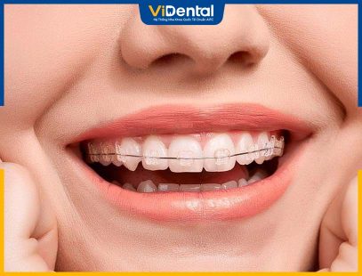 25 Tuổi Niềng Răng Được Không? Phương Pháp Niềng Phù Hợp