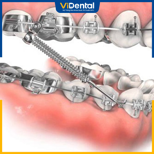 Đeo lò xo niềng răng sẽ có cảm giác đau, khó chịu nhẹ