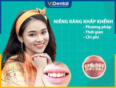 niềng răng khấp khểnh