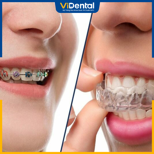 Nhiều người review niềng răng Invisalign có đau nhưng nhẹ hơn các phương pháp truyền thống