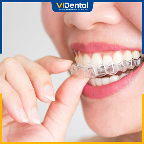 Niềng răng Invisalign là kỹ thuật niềng răng hiện đại, có tính thẩm mỹ cao