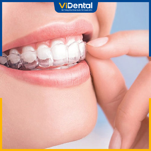 Niềng răng Invisalign là một phương pháp là phương pháp tiên tiến