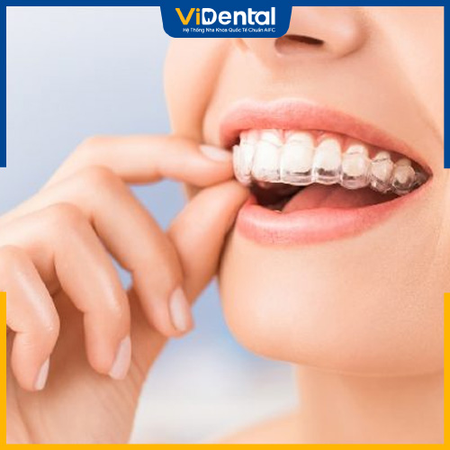 Niềng răng trong suốt Invisalign có tính thẩm mỹ cao