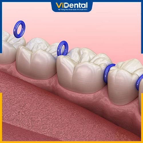 Bạn sẽ cảm thấy đau khi đặt thun tách kẽ