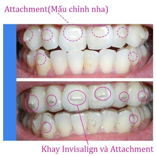 Gắn Attachment làm điểm tựa cố định của khay