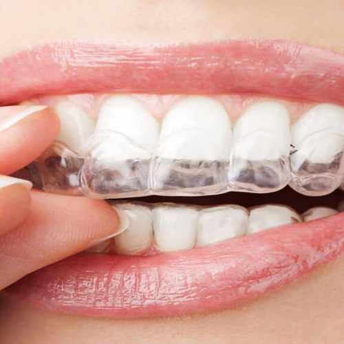 Attachment Invisalign yêu cầu kỹ thuật cao