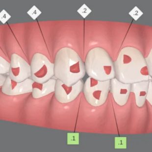 Gắn Attachment Khi Niềng Răng Invisalign: Tác Dụng Và Quy Trình