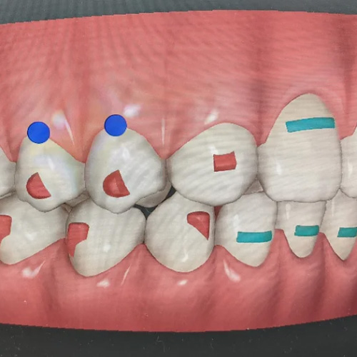 Không phải đối tượng nào cũng có thể gắn Attachment Invisalign